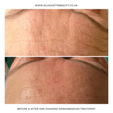 Diamond dermabrasion before and after