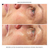Microface Intense results