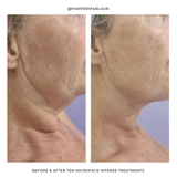 Microface Intense before and after