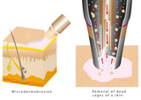 Diamond dermabrasion skin resurfacing treatment